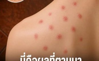 นี่คือผลลัพธ์ที่หลายคนมองข้ามจากการนอนร่วมกับตัวเรือด